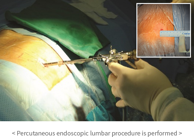 Percutaneous Endoscopic Spinal Procedure