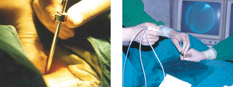 A scene where the cervical disc is being reduced with an endoscopic laser