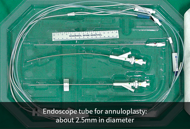 Endoscopic Annuloplasty